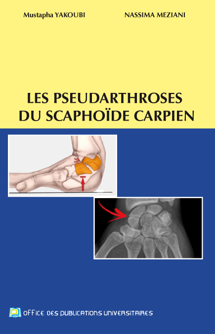 Les pseudarthroses du scaphoïde carpien