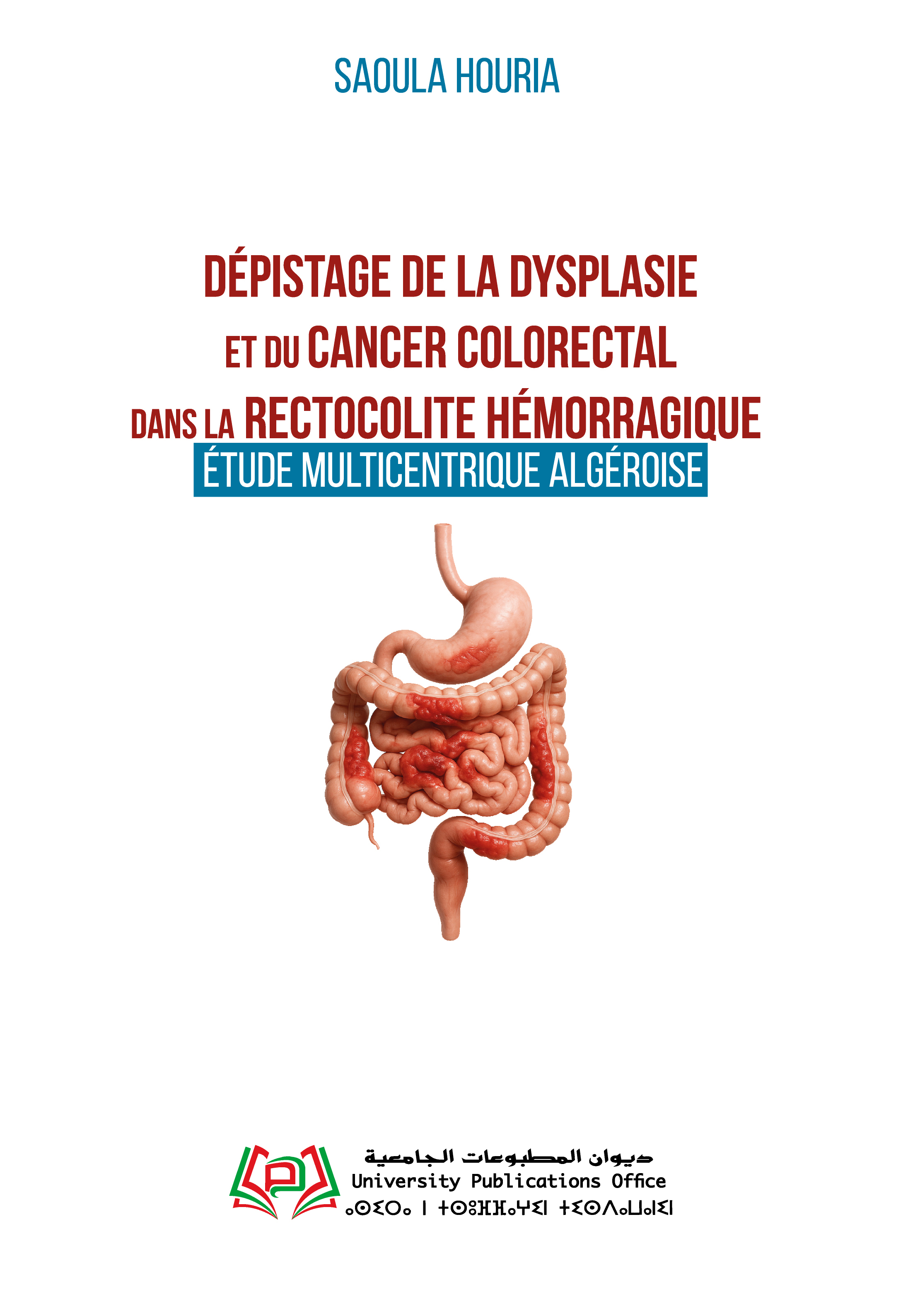 Dépistage de la dysplasie  et du Cancer Colorectal  dans la Rectocolite Hémorragique :  étude multicentrique Algéroise